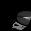 SPORK, NICO - 22.03.1976 - 02.08.2022 - CT obere Extremität - 17:51:17